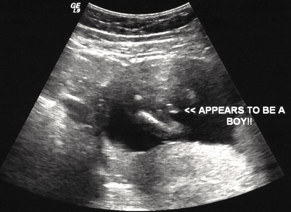 Ultrasound photo